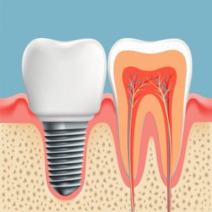 teeth pulp treatment