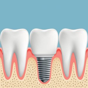 dental implants